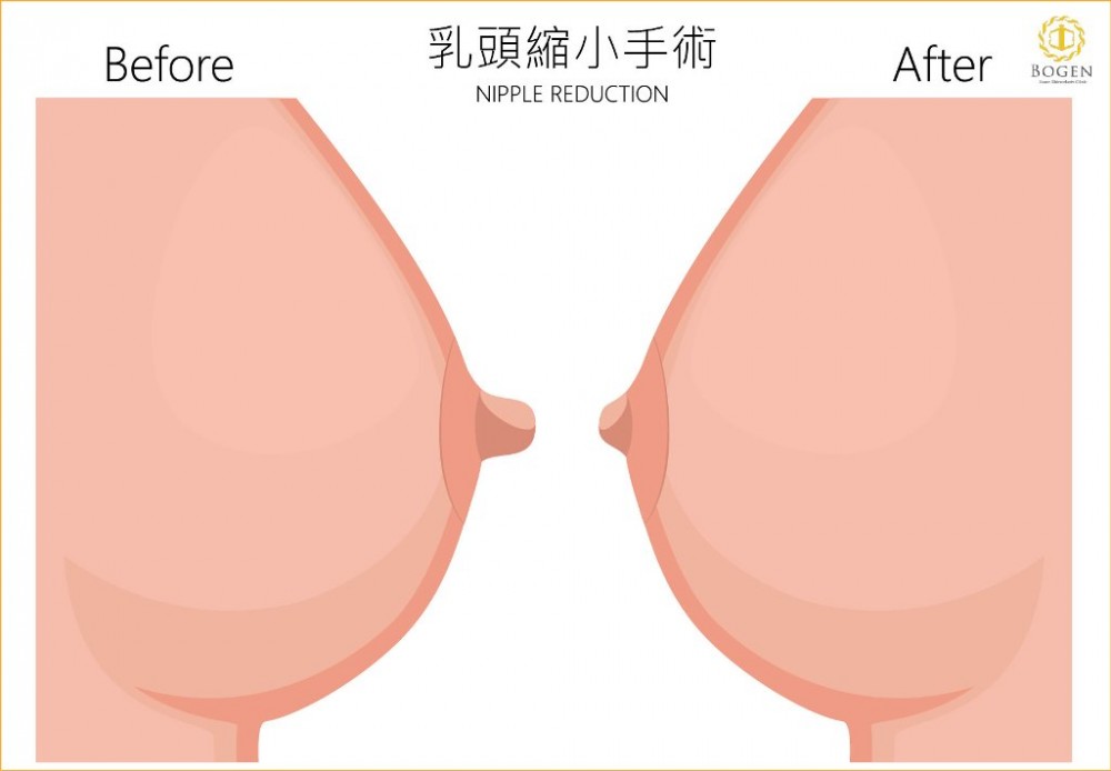 乳頭縮小手術改善乳頭激凸,乳頭縮小手術,博恩妍